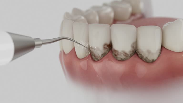 Trusted Wisdom Tooth Removal service in Boalsburg, PA - Dentist Open Now